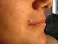 Как бороться с герпесом и его появлением на губах