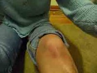 Бурсит коленного сустава лечение